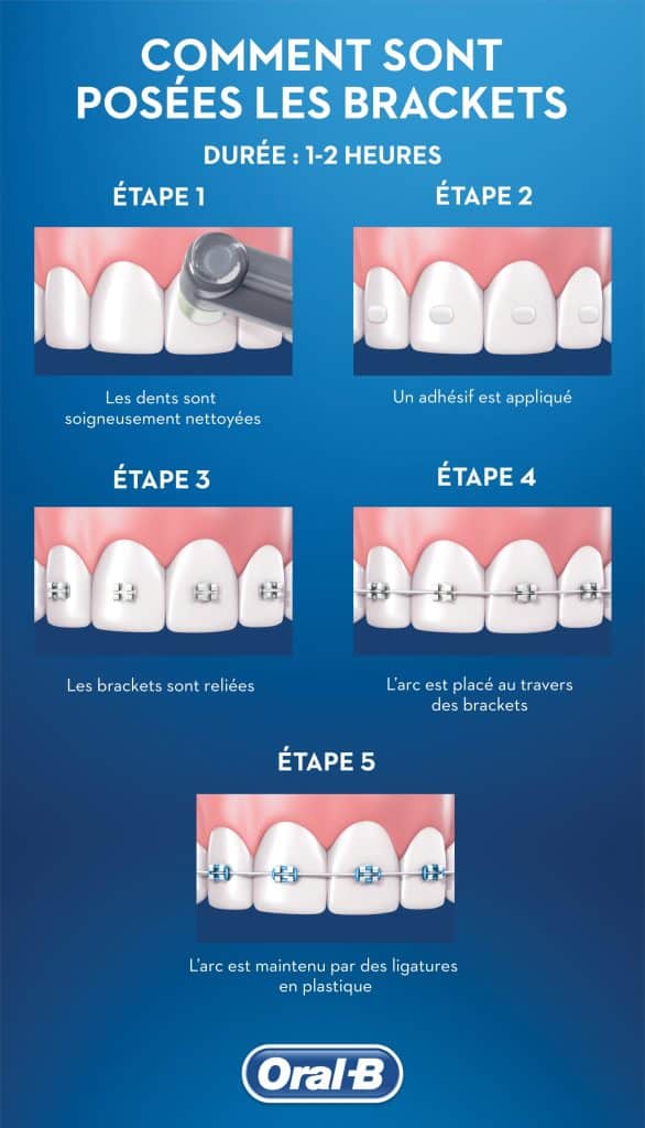 découvrez nos conseils sur l'alimentation après le port de bagues dentaires. apprenez quels aliments privilégier et ceux à éviter pour favoriser une bonne hygiène bucco-dentaire et assurer un confort optimal durant votre traitement orthodontique.